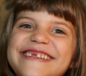 A pulpotomy is like a root canal on a baby tooth
