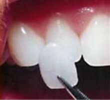 photo of a thin wafer of a porcelain veneer being held up against a prepared front tooth