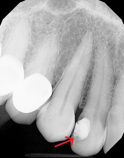 does this tooth need a root canal treatment?