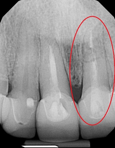 root fracture on tooth in a smile makeover