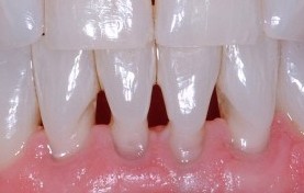 Black triangles from receding gums