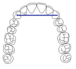 cantilever dental bridge