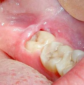 a partially impacted wisdom tooth