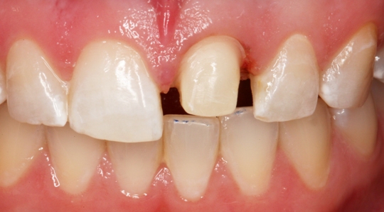 photograph of a smile, showing the patient's left front tooth ground down and prepared for a crown