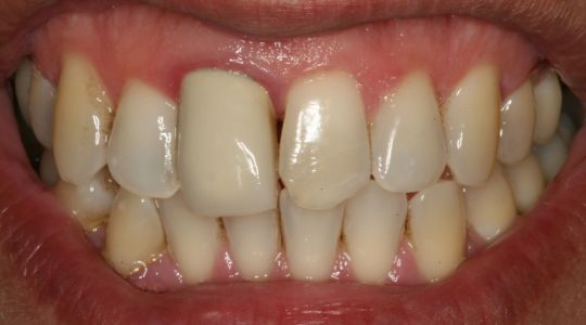 a photo of the front upper and lower teeth, showing a large crown on the right central incisor with inflamed gums around the crown