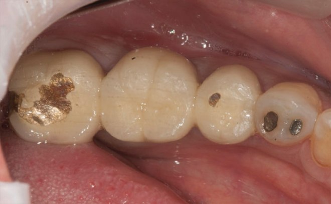 photo of three porcelain-fused-to-metal crowns on back teeth, with metal spots showing through on two of them.