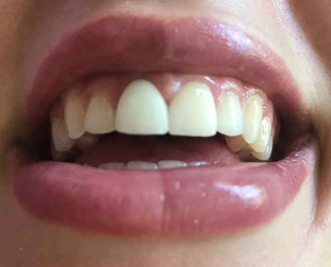 After close-up photograph of smile, with two crowns. One looks brighter and bulkier than the other.