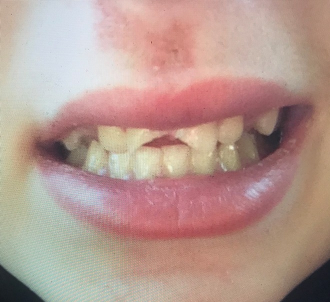 before close-up photograph of a smile showing two front teeth broken off at angles