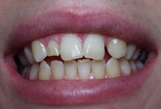 photograph of a smile showing one missing maxillary lateral incisor and on retained baby tooth for the other lateral incisor