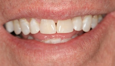 A photo of this smile, after careful cosmetic contouring