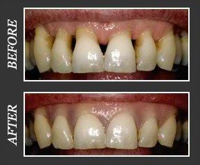 before-and-after photos of a gingival mask. Top photo shows large black triangles between upper front teeth. Bottom shows those filled in with the pink gingival mask material.