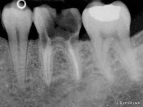 an x-ray of an unrestorable molar tooth that shows decay into the root