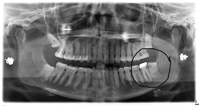A panographic x-ray showing all of Keri's teeth, with a circle drawn around the lower left wisdom tooth and two neighboring teeth.