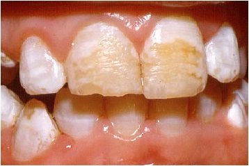 severe enamel hypoplasia, showing deep striations in the enamel of the two front teeth, which has turned brownish 
