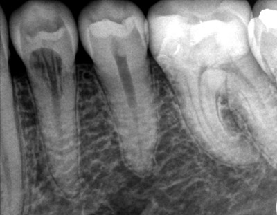 an x-ray of two lower premolars and a molar, showing a dark spot in the middle of the first premolar