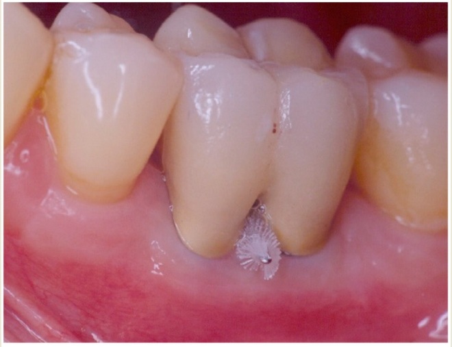 photo of a lower first molar with furcation involvement between the roots and a small brush in that furaction