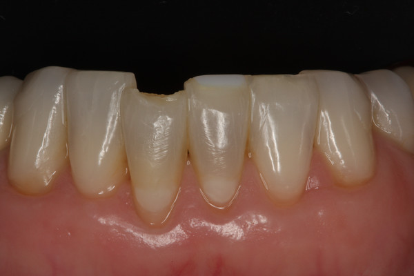 photo of 4 lower incisors with one broken off