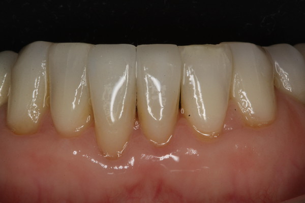 photo of lower incisors, with porcelain veneers on the front two