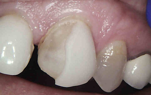 Photo of a tooth showing half of the porcelain veneer fractured off.