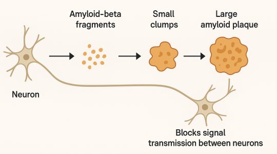a diagram showing how amyloid plaques contribute to Alzheimer's disease by blocking neural transmission