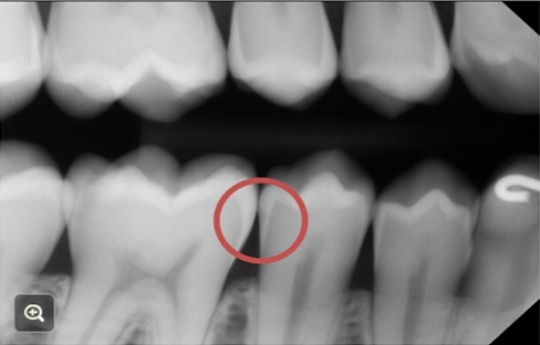 a bitewing x-ray with a circle indicating two lesions - one is incipient caries that has barely penetrated into the dentin, the other is one that is more superficial