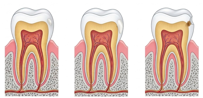 a diagram showing cross sections of 3 teeth showing the progression of a small white spot lesion on the left to full dental caries on the right.