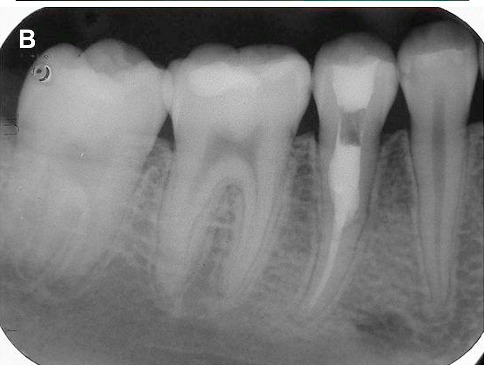 x-ray showing the repair of the second premolar mentioned above.