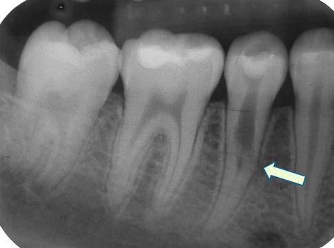x-ray showing two lower molars and two premolars, with internal resorption on the second premolar.