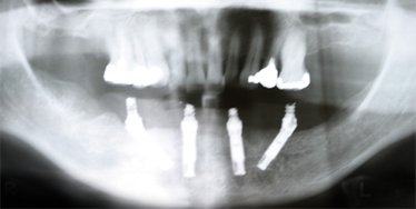 all on four dental implants - x-ray view