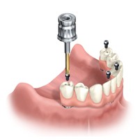 An illustration of placing All-on-Four dental implants