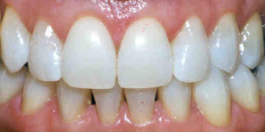 tooth whitening results