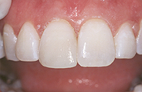 tooth after dental bonding 