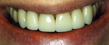 mediocre cosmetic dentistry work