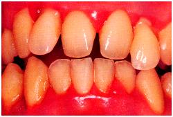 A close-up of bleeding gums