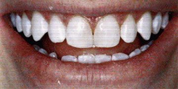After photo of tooth gap repaired with bonding. Patient of Dr. David Hall.