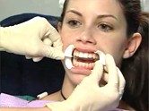 Laser tooth whitening - step one