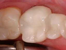 all-porcelain crown on back tooth