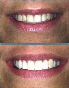 Before and after of tooth bonding