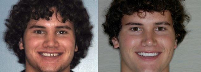 Before & After of Derek's smile makeover.