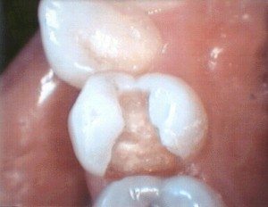 edges of teeth translucent