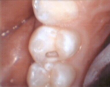 white filling tooth preparation