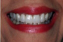 After - Replaced with all-porcelain crowns 