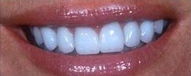 Replaced with all-porcelain crowns by Dr. Larry Addleson 