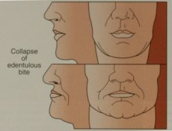Facial Collapse Diagram