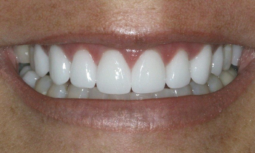 Porcelain Veneer Dentists Cosmetic Dentistry