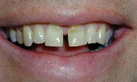 Before - Large gap in front teeth