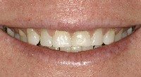 Before - Worn teeth