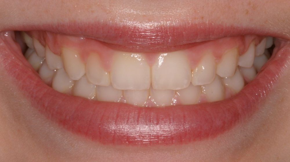 Lumineers | Cosmetic Dentistry