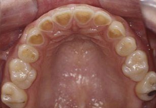 Example of what bulimia does to teeth