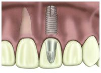 A cosmetic dental implant on a front tooth